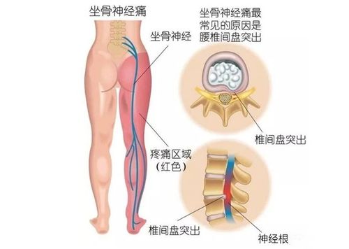 腰間盤(pán)突出做哪些鍛煉方法