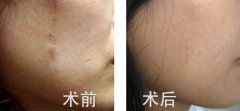 修復疤痕用什么方法有哪些