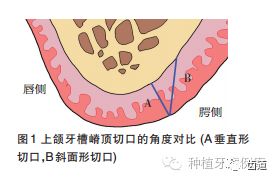 組織切開(kāi)的方法有哪些