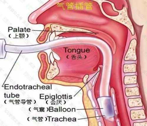 人工氣道的固定方法有哪些