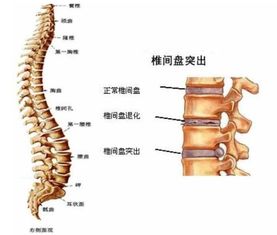 腰椎間盤(pán)膨出的治療方法有哪些