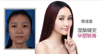 讓內雙變外雙眼皮的方法有哪些