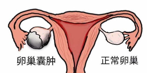 卵巢襄腫手術(shù)有哪些方法