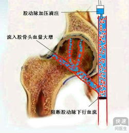 浙江省股骨頭壞死的治療方法中要有哪些