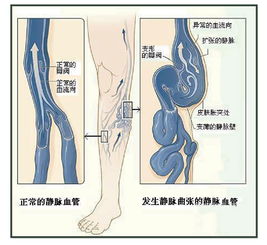 大腿靜脈曲張的治療方法有哪些