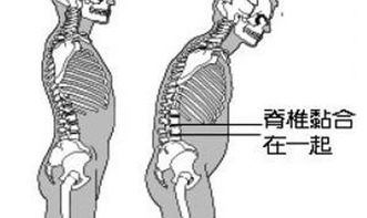 最新強直性脊柱炎治療方法有哪些
