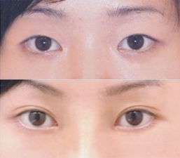非手術(shù)雙眼皮方法有哪些方法有哪些