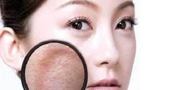 醫美治療毛孔粗大有哪些方法