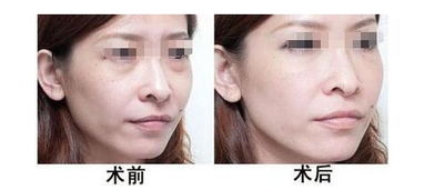 怎么有效的去眼袋的方法有哪些問(wèn)題
