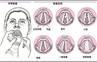 聲帶小結手術(shù)需不需要住院(需不需要作文)