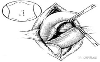 小腸造瘺術(shù)后注意事項,結腸造瘺術(shù)后注意事項,膀胱造瘺術(shù)后注意事項
