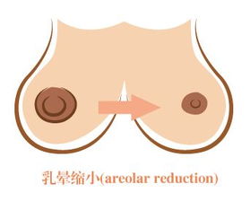 做乳暈變小手術(shù)注意事項,乳暈注射注意事項,激光乳暈嫩紅術(shù)注意事項
