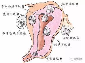 子宮肌瘤患者月經(jīng)期注意事項
