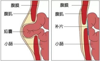 疝氣修補術(shù)后注意事項