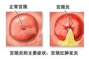 宮頸息肉要注意事項(xiàng)
