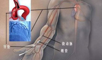 冠脈介入手術(shù)術(shù)后注意事項,冠脈介入進(jìn)修匯報ppt,冠脈介入術(shù)前術(shù)后的注意事項