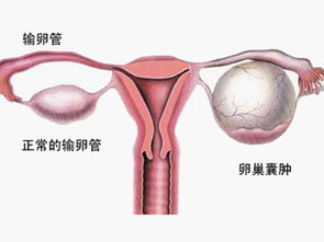 腹腔鏡卵巢囊腫手術(shù)后注意事項