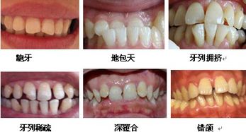 裝隱形牙后24小時(shí)注意事項