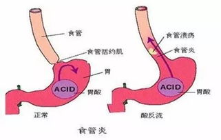 返流性食管炎注意事項