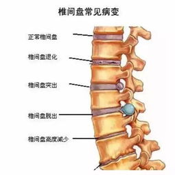腰椎間盤(pán)小關(guān)節綜合癥注意事項