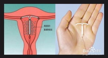 女性上完環(huán)注意事項,上完避孕環(huán)需要注意什么,上環(huán)后應該注意什么事項