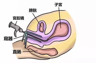 宮腔鏡通液后飲食注意事項