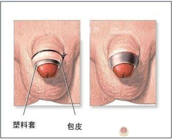 包皮環(huán)切器切除后注意事項