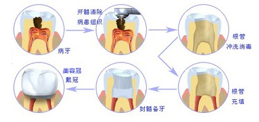 根管治療后有哪些注意事項
