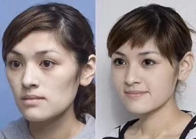 肌注,尿酸,事項,蘋(píng)果