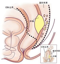 肛門(mén)乳頭瘤手術(shù)后飲食注意事項