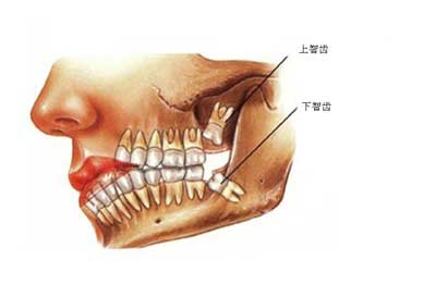 拔智齒后吃什么拔智齒后的注意事項(xiàng)