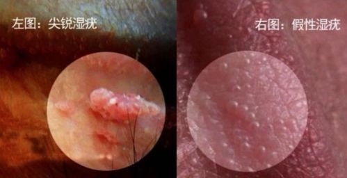 尖銳濕疣注意事項北京軍都診
