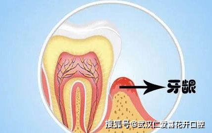 牙槽骨修整術(shù)的注意事項,牙及牙槽骨損傷結扎注意事項,牙槽骨釘注意事項