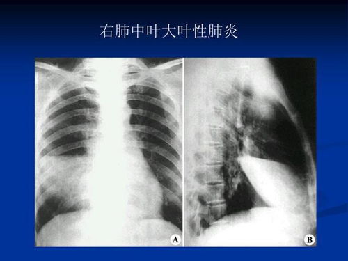 做完核磁后注意事項