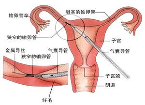 結扎復通術(shù)后注意事項