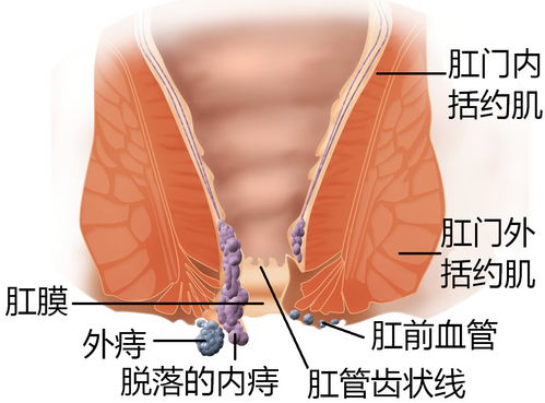 痔瘡肛瘺術(shù)前術(shù)后注意事項