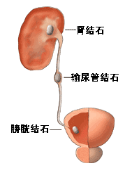尿路結石術(shù)后注意事項有哪些,尿路結石插管術(shù)后注意事項,尿路結石微創(chuàng  )手術(shù)后注意事項