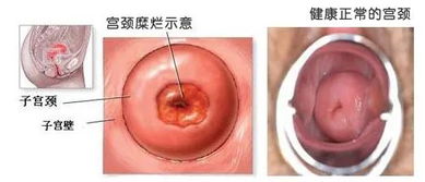 做完宮頸糜爛手術(shù)后注意事項