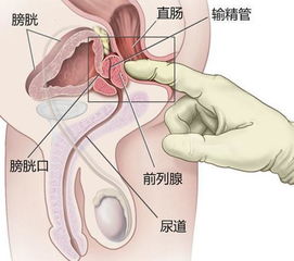 前列腺結石注意事項