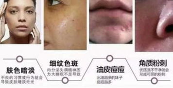 mts皮膚管理后注意事項,mts皮膚管理的功效,mts皮膚管理是什么意思
