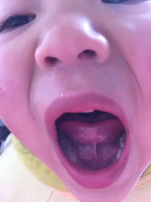 舌細帶手術(shù)注意事項