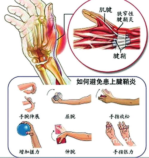 大拇指腱鞘炎注意事項(xiàng)