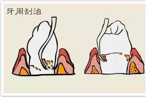 牙齒刮治后的注意事項