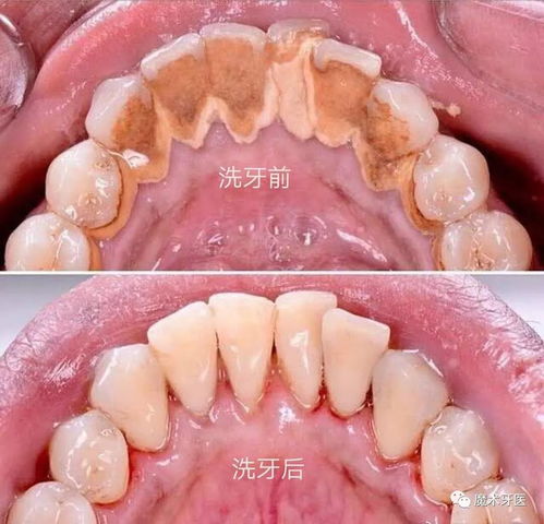 牙周炎洗牙后注意事項
