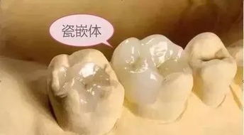 嵌體的適應癥及臨床注意事項