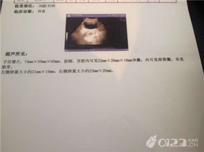 女性查體前一天注意事項,女性b超檢查注意事項,女性做b超注意事項