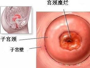 宮頸糜爛日常注意事項,宮頸糜爛注意事項有哪些,微波治療宮頸糜爛后注意事項