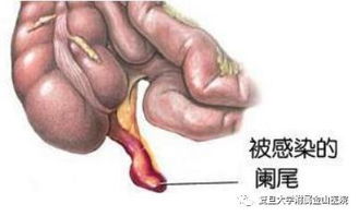 闌尾炎,開(kāi)刀,注意事項