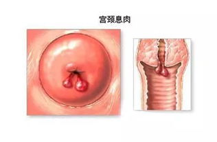 宮頸息肉注意事項(xiàng),宮頸息肉治療后注意事項(xiàng),宮頸息肉術(shù)后注意事項(xiàng)