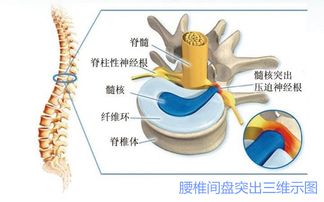 腰椎間盤(pán)突出癥患者注意事項有哪些呢?,腰椎間盤(pán)突出癥的注意事項,腰椎間盤(pán)突出癥出院注意事項